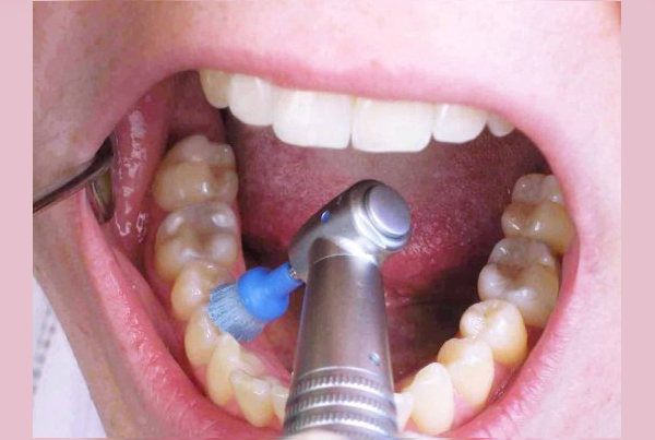 Teeth Cleaning  Polishing