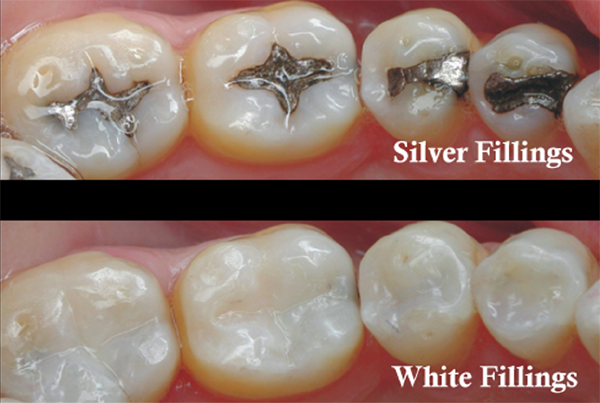 Tooth Coloured Fillings