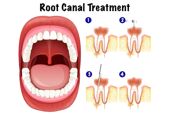 Root Canal Treatment  RCT