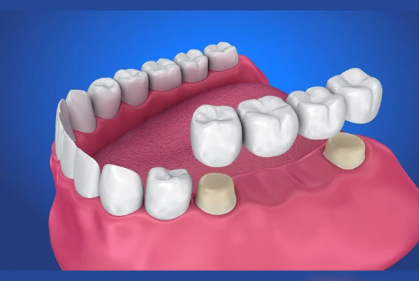 Ceramic Crown & Bridge