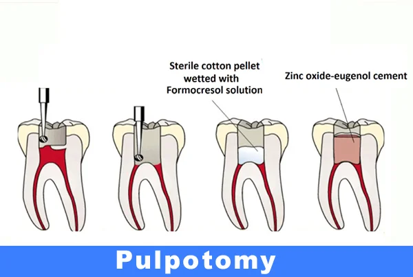 Pulpotomy