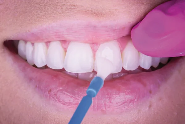 Fluoride Application