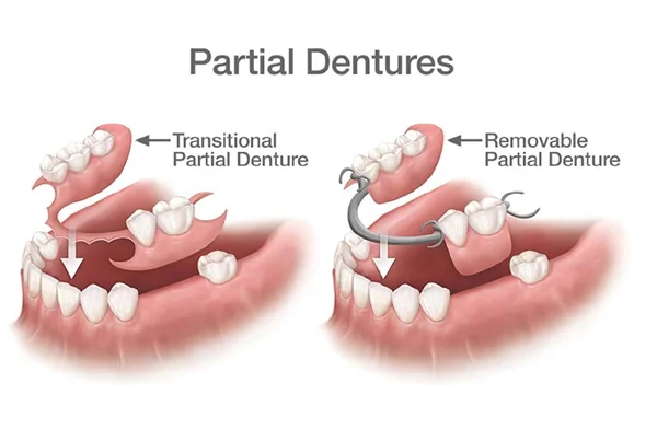 Complete Denture and Removable Partial Denture