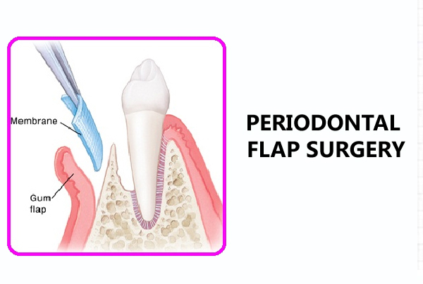Periodontal Flap Surgery