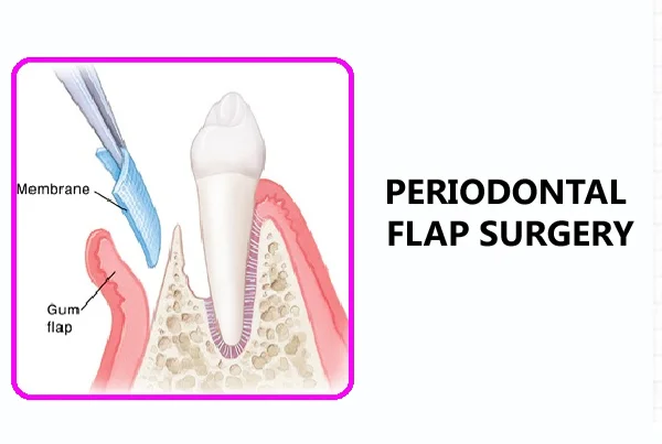 Periodontal Flap Surgery