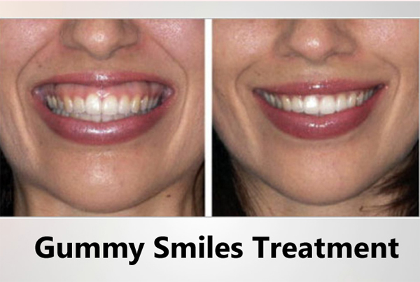 Gummy Smile